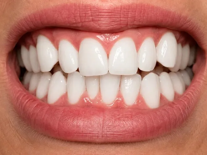 بعد: ارتودنسی و بلیچینگ