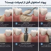 پیوند استخوان قبل از ایمپلنت چیست و چه زمانی به آن نیاز داریم؟