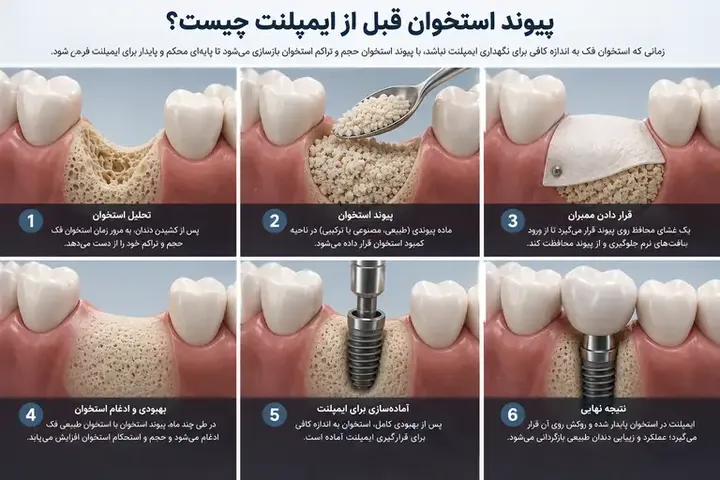 پیوند استخوان قبل از ایمپلنت چیست و چه زمانی به آن نیاز داریم؟