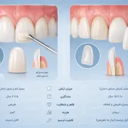 لمینت بهتر است یا کامپوزیت؟ مقایسه کامل مزایا، معایب، ماندگاری و زیبایی