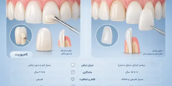 لمینت بهتر است یا کامپوزیت؟ مقایسه کامل مزایا، معایب، ماندگاری و زیبایی