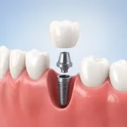 بهترین سن برای ایمپلنت دندان چیست؟ حداقل و حداکثر سن مناسب کاشت ایمپلنت