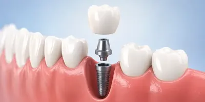 بهترین سن برای ایمپلنت دندان چیست؟ حداقل و حداکثر سن مناسب کاشت ایمپلنت