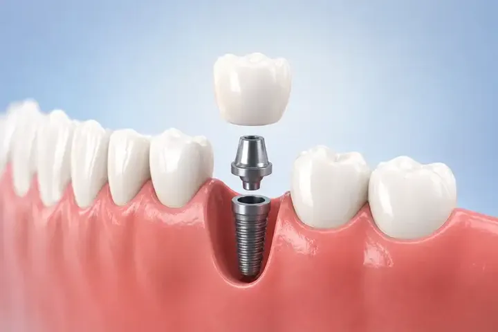 بهترین سن برای ایمپلنت دندان چیست؟ حداقل و حداکثر سن مناسب کاشت ایمپلنت