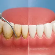 جرم‌گیری دندان چیست و هر چند وقت یک‌بار باید انجام شود؟