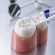 فیشور سیلانت چیست و چرا برای کودکان اهمیت دارد؟