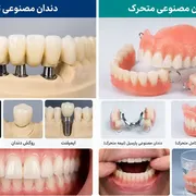 دندان مصنوعی ثابت و متحرک: راهنمای کامل انتخاب، مراقبت و تفاوت‌ها