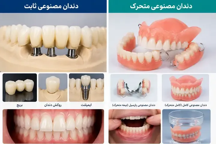 دندان مصنوعی ثابت و متحرک: راهنمای کامل انتخاب، مراقبت و تفاوت‌ها