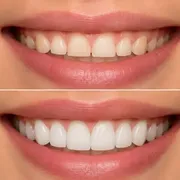 چگونه دندان‌های کوتاه را با لمینت بلندتر کنیم؟ راهنمای جامع