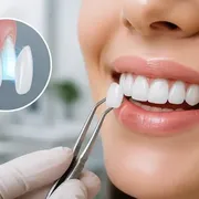 لمینت بدون تراش در کاشان؛ راه حلی مدرن برای زیبایی دندان