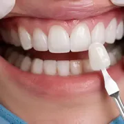 لمینت بدون تراش (لومینیرز) چیست؟ آیا واقعاً بدون تراش دندان می‌توان لبخندی زیبا داشت؟