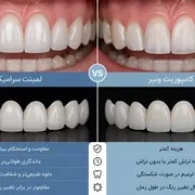 لمینت سرامیکی بهتر است یا کامپوزیت ونیر؟ مقایسه کامل مزایا، معایب، ماندگاری و هزینه