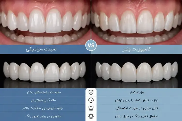 لمینت سرامیکی بهتر است یا کامپوزیت ونیر؟ مقایسه کامل مزایا، معایب، ماندگاری و هزینه