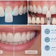 آیا می‌توان فقط یک دندان را لمینت کرد؟ بررسی کامل لمینت تک دندان و هماهنگی رنگ با دندان‌های طبیعی