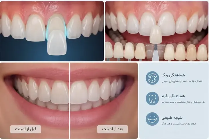 آیا می‌توان فقط یک دندان را لمینت کرد؟ بررسی کامل لمینت تک دندان و هماهنگی رنگ با دندان‌های طبیعی