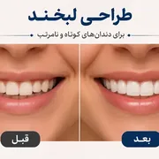 طراحی لبخند برای دندان‌های کوتاه و نامرتب؛ چه روش‌هایی وجود دارد؟