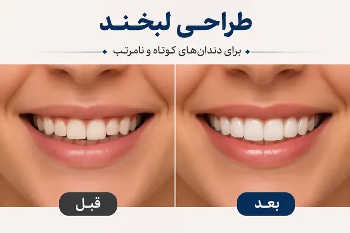 طراحی لبخند برای دندان‌های کوتاه و نامرتب؛ چه روش‌هایی وجود دارد؟
