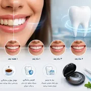 ماندگاری بلیچینگ دندان چقدر است؟ راهنمای کامل افزایش دوام سفیدی دندان‌ها
