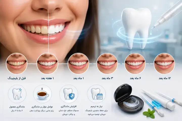 ماندگاری بلیچینگ دندان چقدر است؟ راهنمای کامل افزایش دوام سفیدی دندان‌ها
