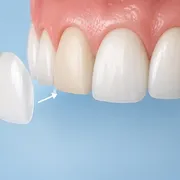 لمینت دندان چیست، چطور انجام می‌شود و آیا برای شما مناسب است؟