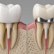 روکش زیرکونیا بهتر است یا PFM؟ بهترین روکش برای دندان عصب‌کشی شده
